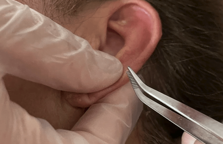 Porque dói o ponto da auriculoterapia?