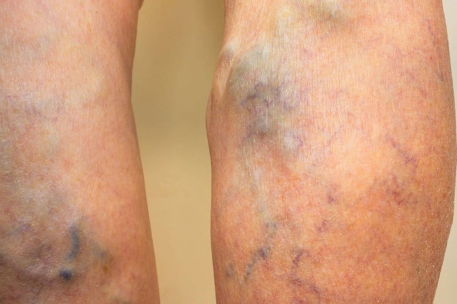 trombose venosa profunda